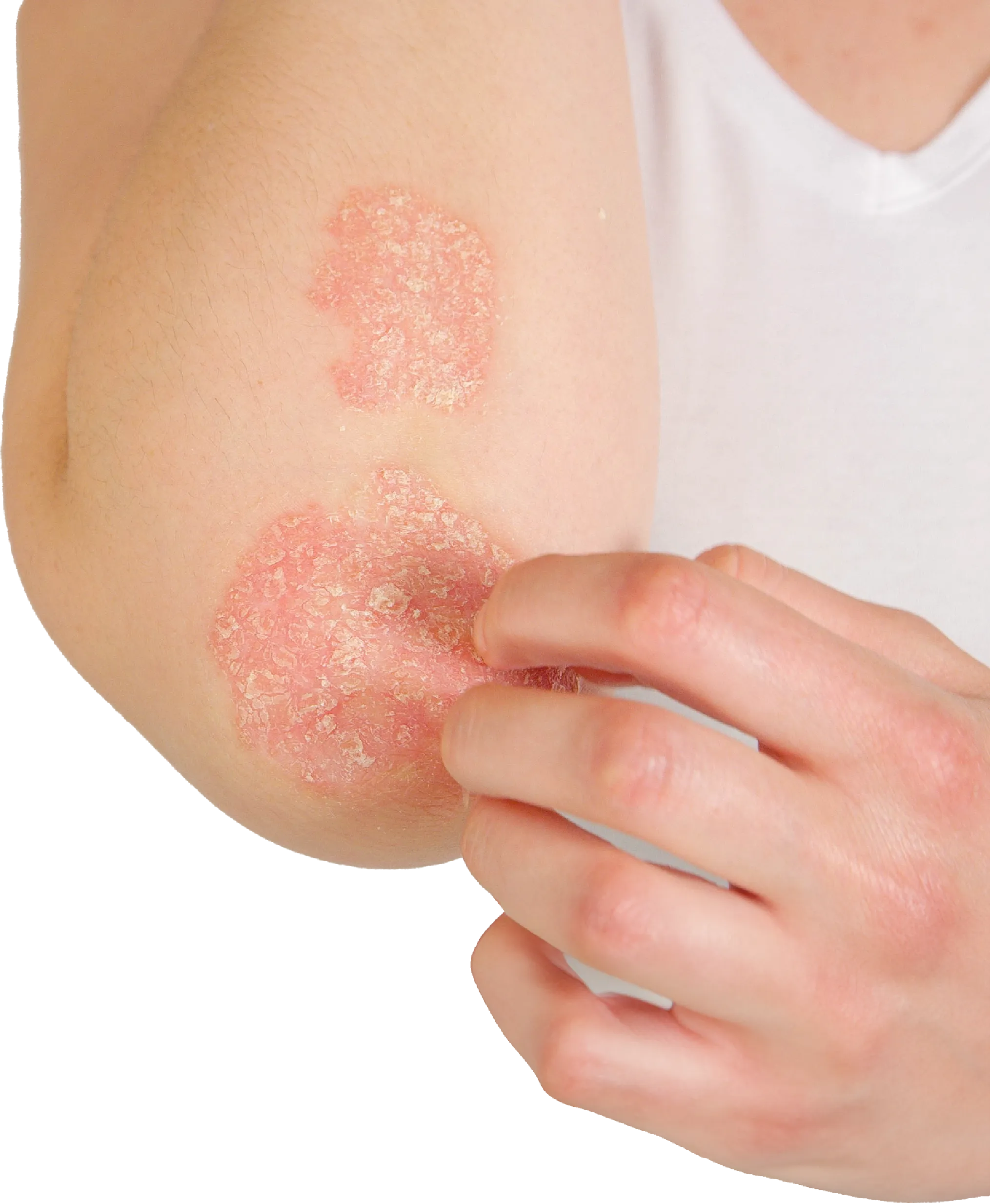Psoriasis